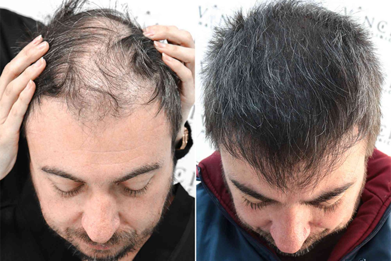 Hair Transplant Turkey